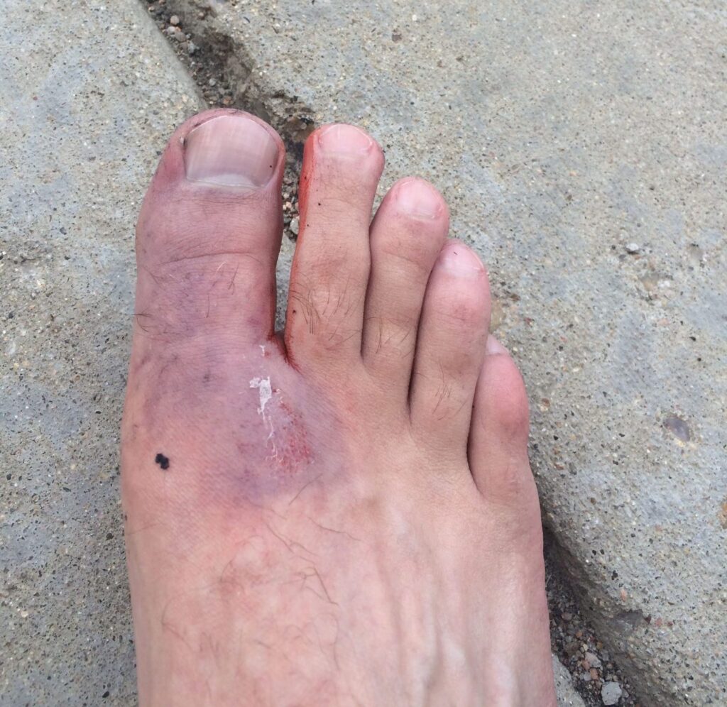 Gym Fail, Broke foot, black and blue, bruised foot