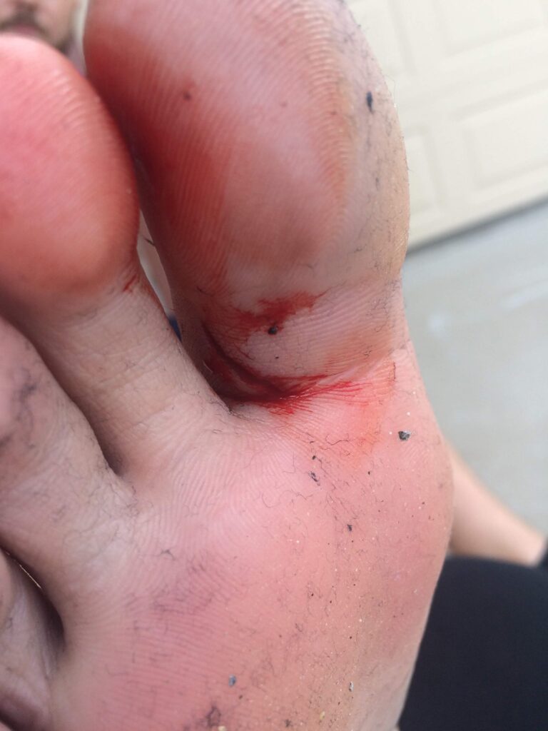 1-inch gash, bottom of foot, foot explosion