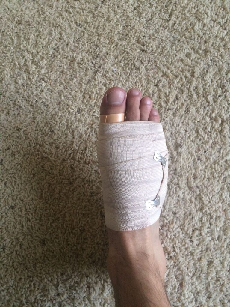 Ace Bandage for broken foot, foot wrap