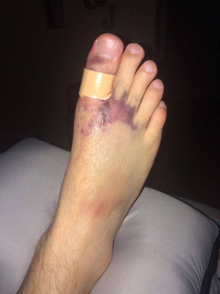 Badly Bruised and broken foot, black and blue foot