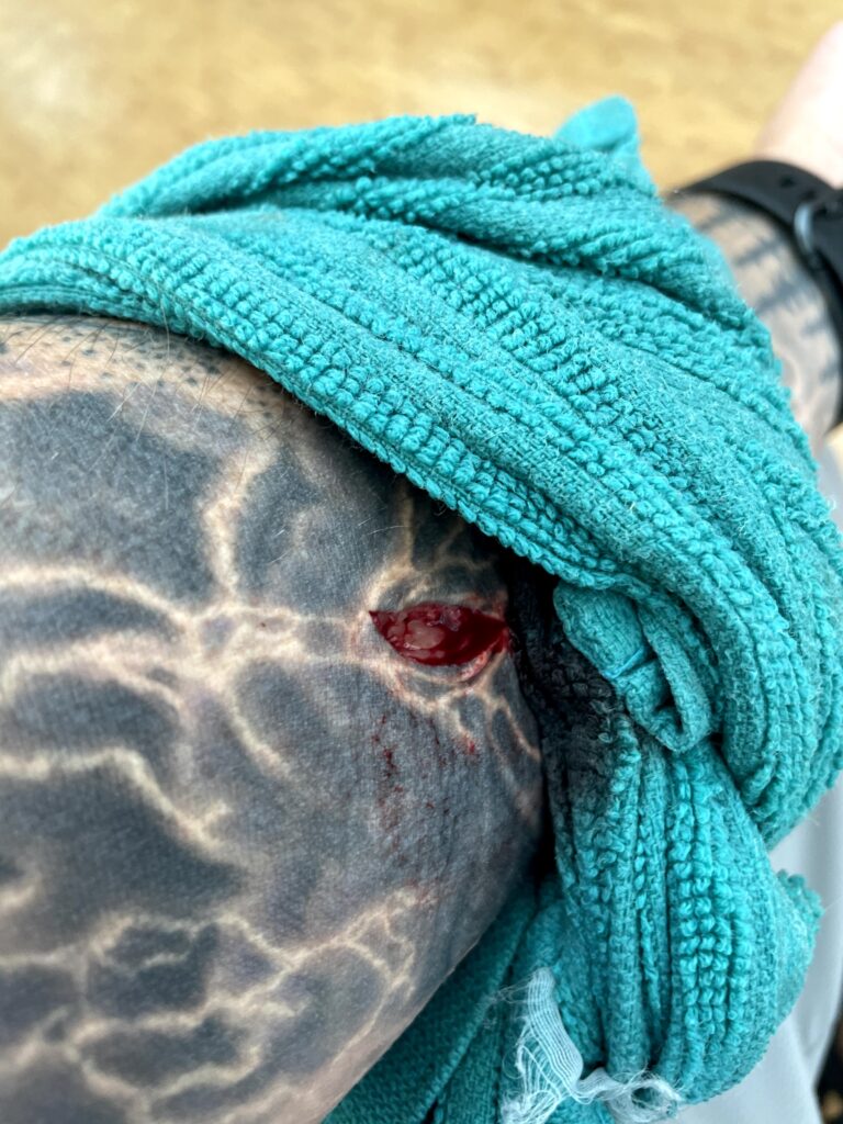 An Unexpected Stabbing, Stab wound